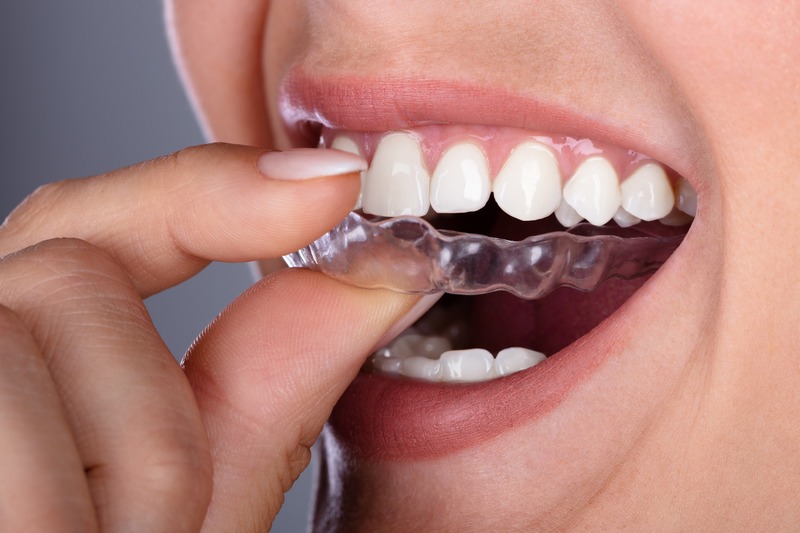 A woman puts a clear aligner on her top teeth after having learned about Invisalign facts.