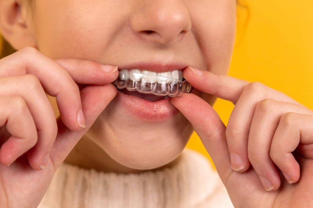 close up of a child putting invisalign first into their mouth.