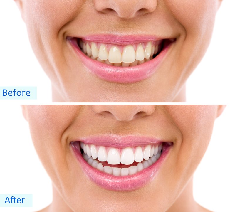 Before and after a professional teeth whitening with a san francisco cosmetic dentist