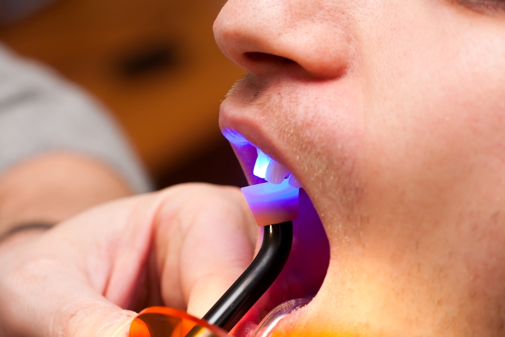 dentist using light during cosmetic bonding procedure